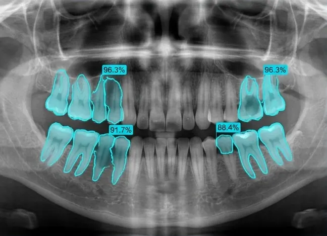 Procen's pixel-level tooth segmentation masks with confidence scores on a panoramic X-ray